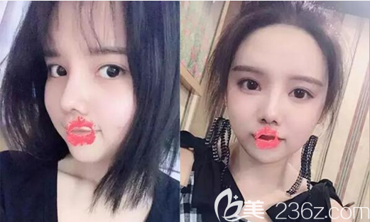 在閨蜜的推薦下，我到整形美容醫(yī)院做了鼻綜合和全面部自體脂肪填充手術(shù)