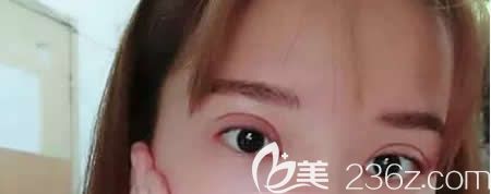 <!--<i data=20240703-sp></i>-->醫(yī)院找史希杰院長(zhǎng)給我做平行雙眼皮術(shù)后第7天效果 <!--<i data=20240703-sp></i>-->醫(yī)院找史希杰院長(zhǎng)給我做平行雙眼皮術(shù)后第7天效果