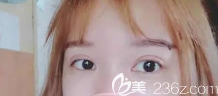 <!--<i data=20240703-sp></i>-->醫(yī)院找史希杰院長(zhǎng)給我做平行雙眼皮術(shù)后第18天效果 <!--<i data=20240703-sp></i>-->醫(yī)院找史希杰院長(zhǎng)給我做平行雙眼皮術(shù)后第18天效果