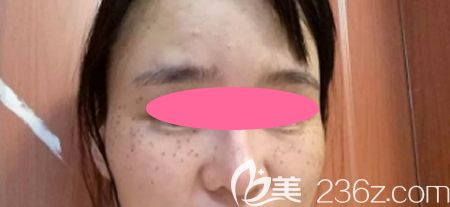 去景德鎮(zhèn)圣嘉麗整形做皮秒激光祛斑治療后第4天效果 去景德鎮(zhèn)圣嘉麗整形做皮秒激光祛斑治療后第4天效果