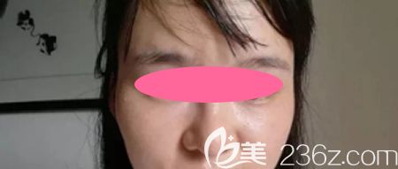 去景德鎮(zhèn)圣嘉麗整形做皮秒激光祛斑治療后第8天效果 去景德鎮(zhèn)圣嘉麗整形做皮秒激光祛斑治療后第8天效果