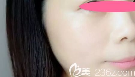 曬一下我去景德鎮(zhèn)圣嘉麗整形做皮秒祛斑10天恢復過程圖及效果