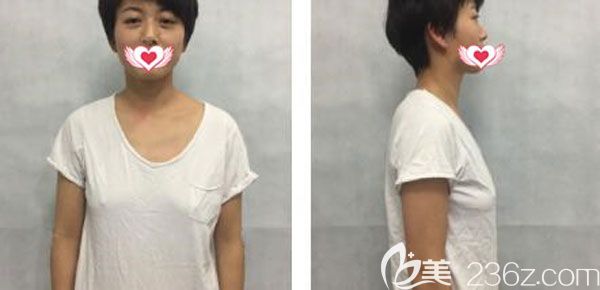 在<!--<i data=20240703-sp></i>-->美萊做隆胸手術(shù)前 在<!--<i data=20240703-sp></i>-->美萊做隆胸手術(shù)前