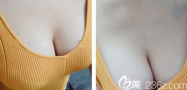 假體隆胸20天手感摸著有點硬 假體隆胸20天手感摸著有點硬