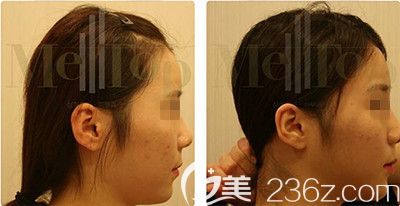 骨水泥后腦勺填充案例 骨水泥后腦勺填充案例