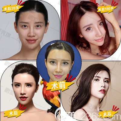 深圳鵬愛秀琪譚濤醫(yī)生做的鼻綜合隆鼻案例 深圳鵬愛秀琪譚濤醫(yī)生做的鼻綜合隆鼻案例