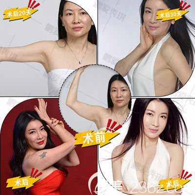 深圳鵬愛秀琪譚濤吸脂案例 深圳鵬愛秀琪譚濤吸脂案例