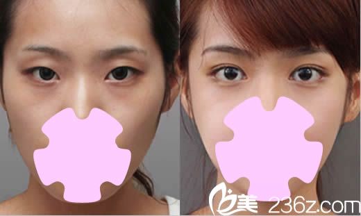 北京美萊整形雙眼皮案例效果圖