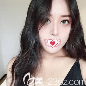 孟祥<!--<i data=20240703-sp></i>-->生為我做鼻綜合術后18天慢慢消腫 孟祥<!--<i data=20240703-sp></i>-->生為我做鼻綜合術后18天慢慢消腫