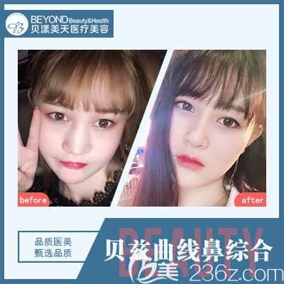 深圳貝漾美天董磊醫(yī)生合隆鼻案例