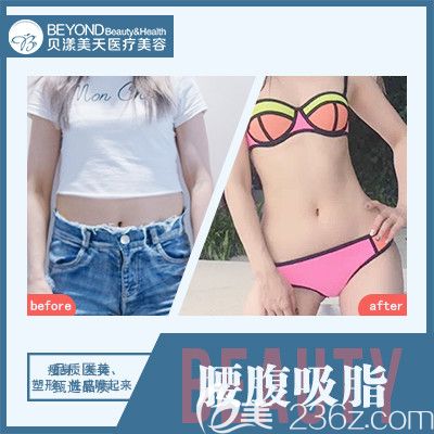 深圳貝漾美天董磊腰腹部吸脂案