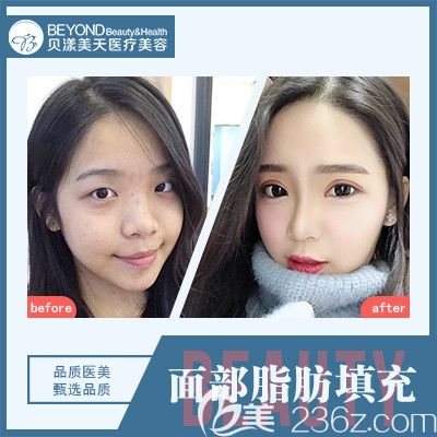 深圳貝漾美天董磊醫(yī)生自體脂肪面部填充案例