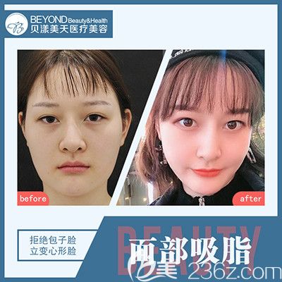 深圳貝漾美天董磊面部吸脂案例