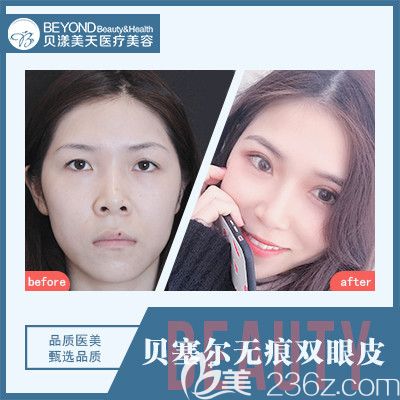 深圳貝漾美天曹思佳院長雙眼皮案例
