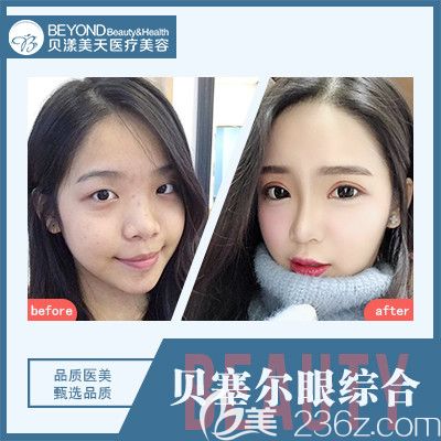 深圳貝漾美天曹思佳院長貝塞爾眼綜合案例