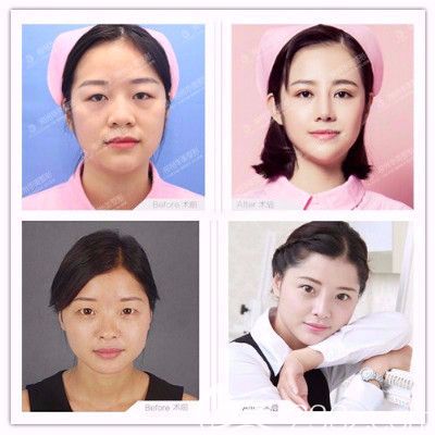 柳州華美王文醫(yī)生做的雙眼皮