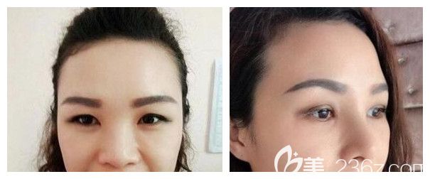 南寧夢(mèng)想整形肋軟骨鼻綜合隆鼻案例 南寧夢(mèng)想整形肋軟骨鼻綜合隆鼻案例