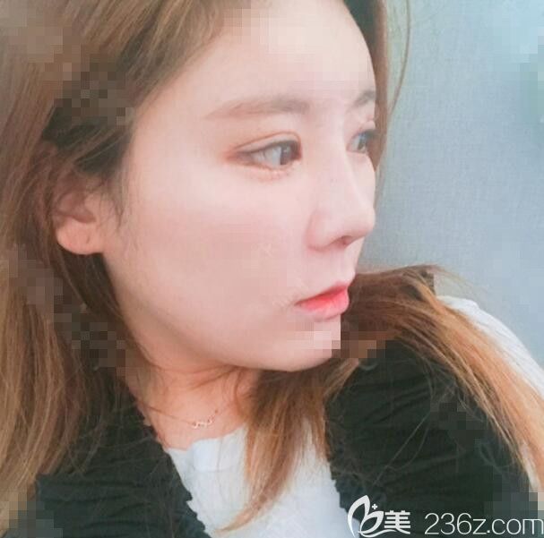 手術(shù)后一周 手術(shù)后一周