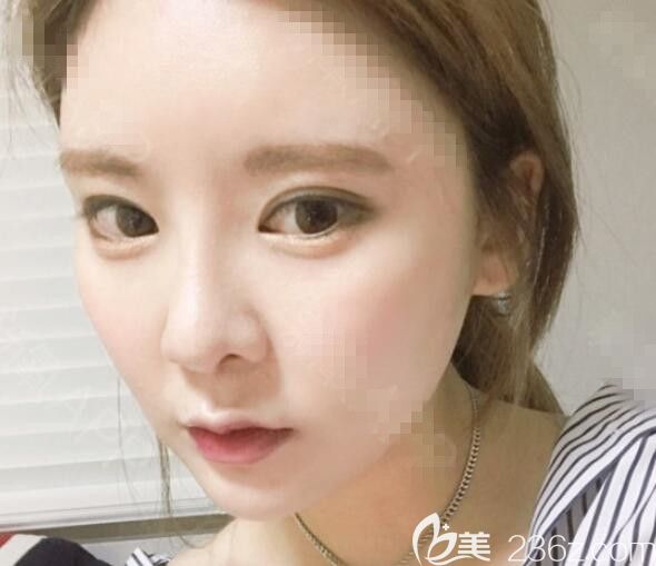 佳輪韓金男昊下頜角顴骨安泰柱雙眼皮鼻子脂肪填充5個月后感覺自己好夸張