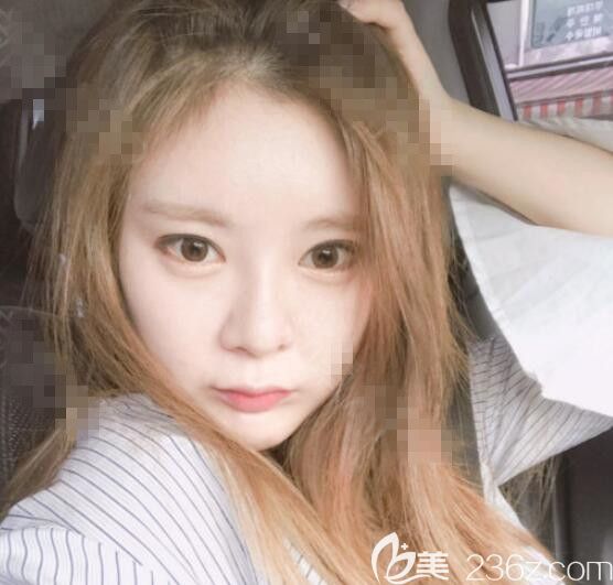 佳輪韓安泰柱院長雙眼皮隆鼻真人案例 佳輪韓安泰柱院長雙眼皮隆鼻真人案例