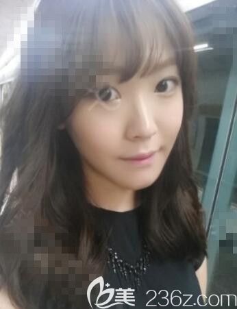 高顴骨好老氣在韓國NJH盧鐘勛整形做了顴骨術后2個月我變成了鄰家妹妹