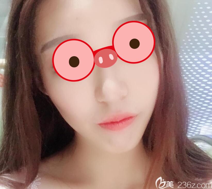 面部抽脂瘦臉半個(gè)月 面部抽脂瘦臉半個(gè)月