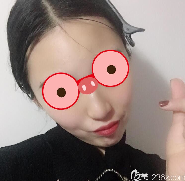 合肥福華整形面部吸脂21效果圖 合肥福華整形面部吸脂21效果圖