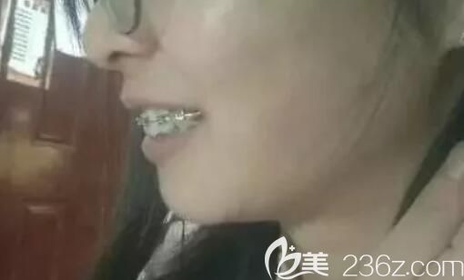 <!--<i data=20240703-sp></i>-->臻威口腔齙牙戴鋼絲牙套矯正250天 <!--<i data=20240703-sp></i>-->臻威口腔齙牙戴鋼絲牙套矯正250天