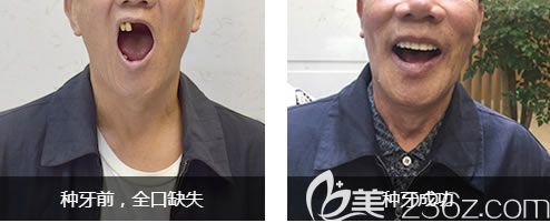 天津中諾口腔趙振宇立得用種植牙前后對(duì)比效果 天津中諾口腔趙振宇立得用種植牙前后對(duì)比效果