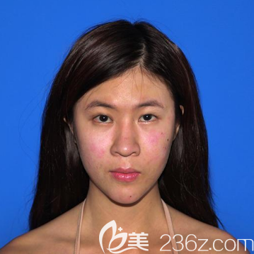 去廣州中家醫(yī)家庭整形醫(yī)院做手術(shù)前的樣子 去廣州中家醫(yī)家庭整形醫(yī)院做手術(shù)前的樣子