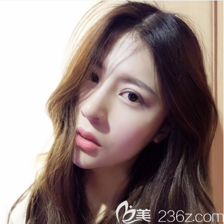 雙眼皮隆鼻術(shù)后一個(gè)月恢復(fù)照片 雙眼皮隆鼻術(shù)后一個(gè)月恢復(fù)照片