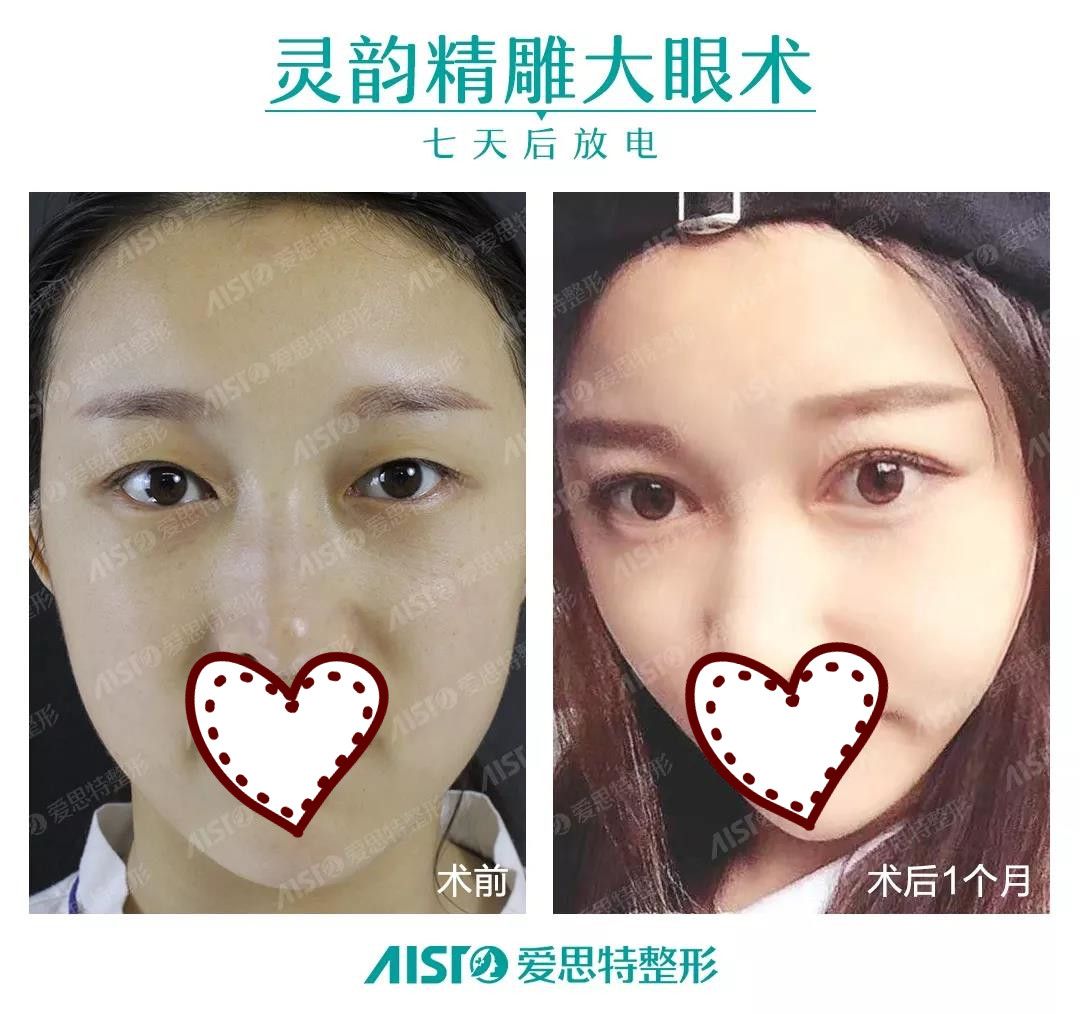 南寧愛思特整形精雕雙眼皮案例