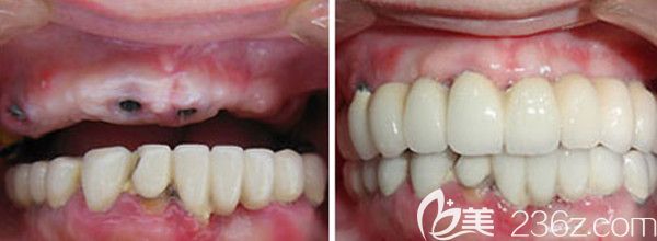 ALL-on-4半口種植前后對比圖