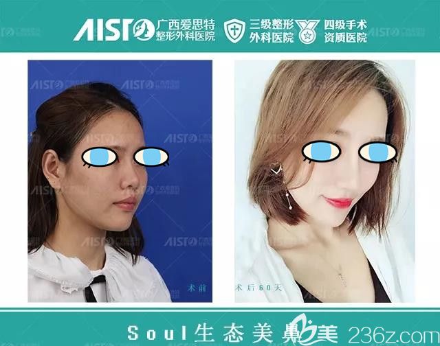 南寧愛思特整形鼻綜合隆鼻案例