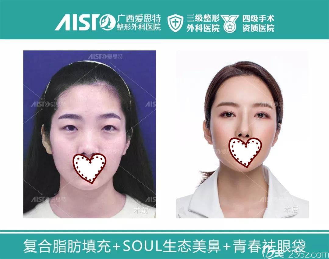 南寧愛思特整形全臉自體脂肪填充案例