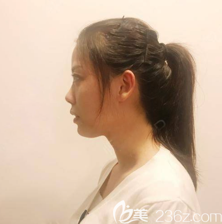 去廣州美萊做鼻修復(fù)前的側(cè)面照片 去廣州美萊做鼻修復(fù)前的側(cè)面照片