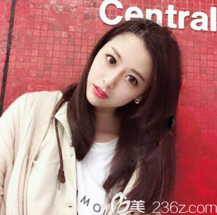 隆鼻術(shù)后恢復(fù)照片 隆鼻術(shù)后恢復(fù)照片