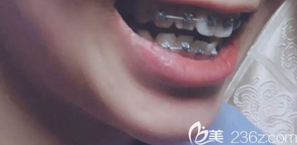 剛帶上金屬托槽牙套的時(shí)候 剛帶上金屬托槽牙套的時(shí)候