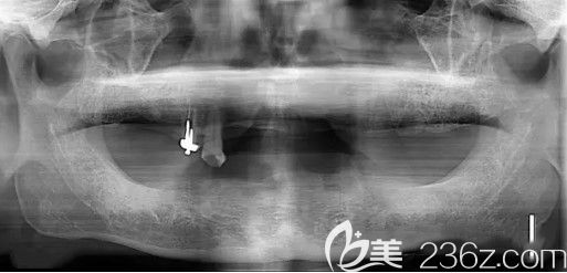 我全口牙缺失在天津中諾口腔做種植牙前CT片 我全口牙缺失在天津中諾口腔做種植牙前CT片