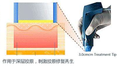 熱瑪吉除皺原理