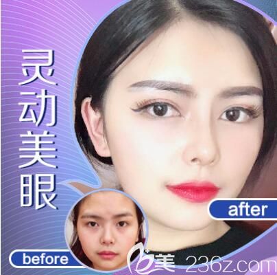 重慶五洲整形割雙眼皮案例