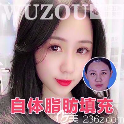 五洲整形自體脂肪全臉填充