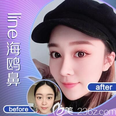 重慶五洲整形隆鼻