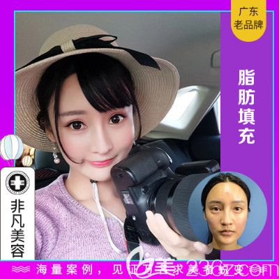 深圳非凡梁全毅醫(yī)生面部自體脂肪填充案例 深圳非凡梁全毅醫(yī)生面部自體脂肪填充案例