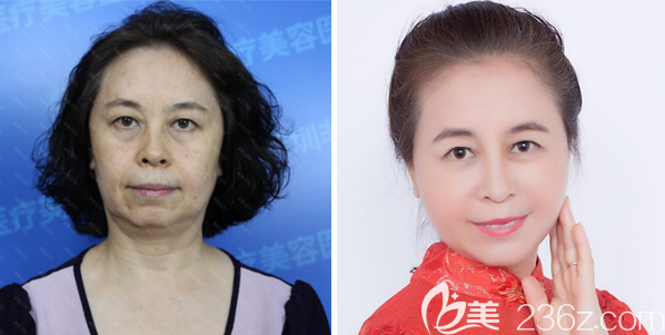 深圳非凡梁全毅醫(yī)生臉部填脂案例 深圳非凡梁全毅醫(yī)生臉部填脂案例