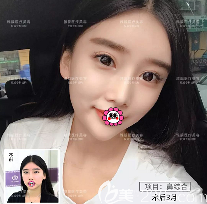 北京雅靚岳才醫(yī)生鼻綜合案例