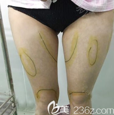去<!--<i data=20240703-sp></i>-->做大腿吸脂前的圖片 去<!--<i data=20240703-sp></i>-->做大腿吸脂前的圖片