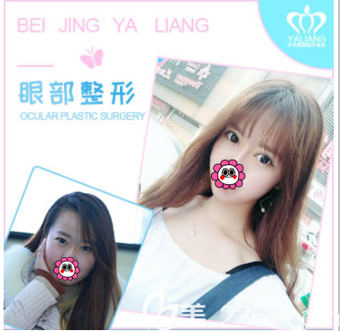 北京雅靚陳林葉醫(yī)生切開雙眼皮案例 北京雅靚陳林葉醫(yī)生切開雙眼皮案例