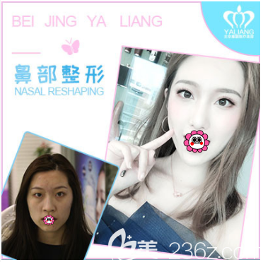 北京雅靚陳林葉醫(yī)生肋軟骨隆鼻案例 北京雅靚陳林葉醫(yī)生肋軟骨隆鼻案例