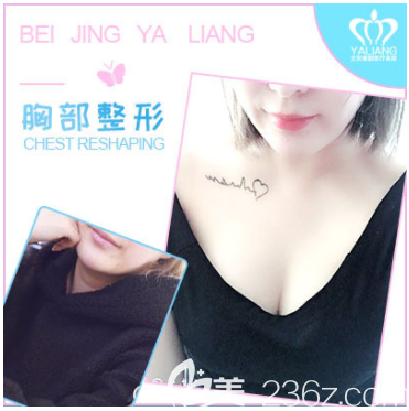 北京雅靚張春彥醫(yī)生自體脂肪豐胸案例 北京雅靚張春彥醫(yī)生自體脂肪豐胸案例